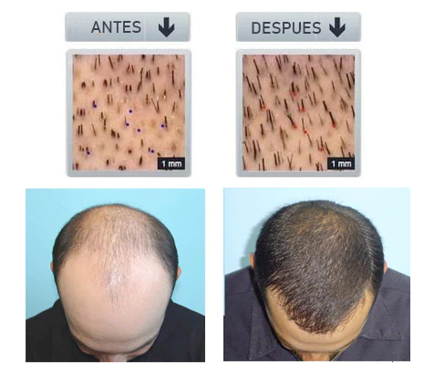 SPRAY PARA ALOPECIA - HyperSpray™