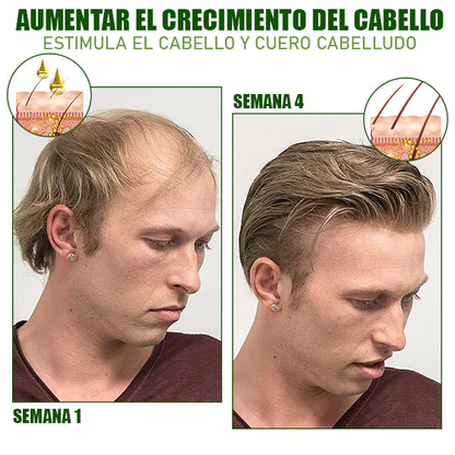 SPRAY PARA ALOPECIA - HyperSpray™